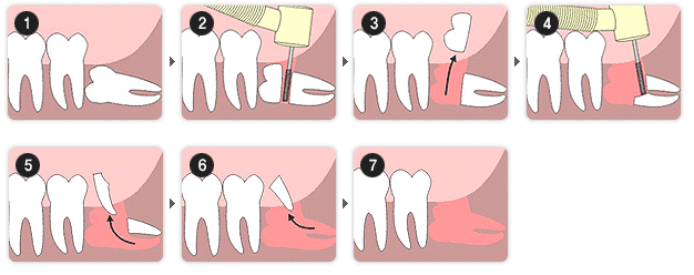 拔除智齿有危害吗?