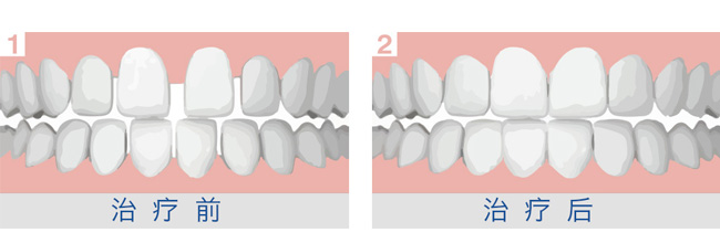门牙有缝,担心矫正过程不美观,怎么办?