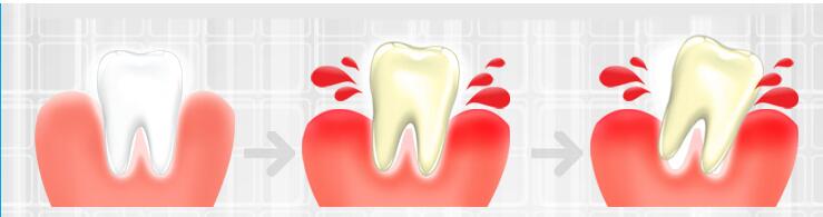 哪些人比较容易牙龈出血?